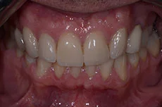 veneers07b4.jpg