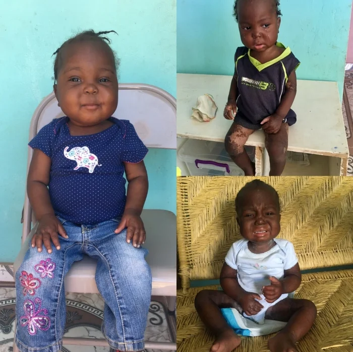 Asline's road to recovery was long and difficult, but we are so thankful for the chubby cheeked little girl we see today. She has come so far during her time at Potter & Clay.
