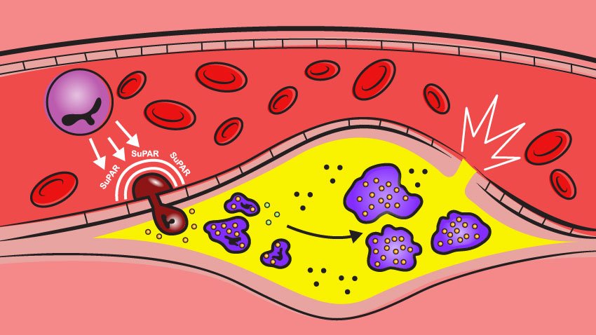 suPar-cells-plaque-blood-vessel.jpg