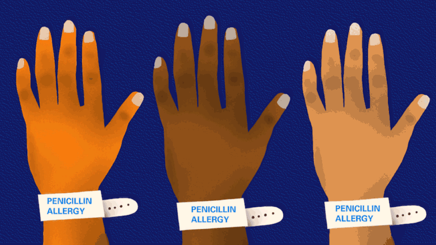 penicillin-allergy-hands-wrist-blue.gif