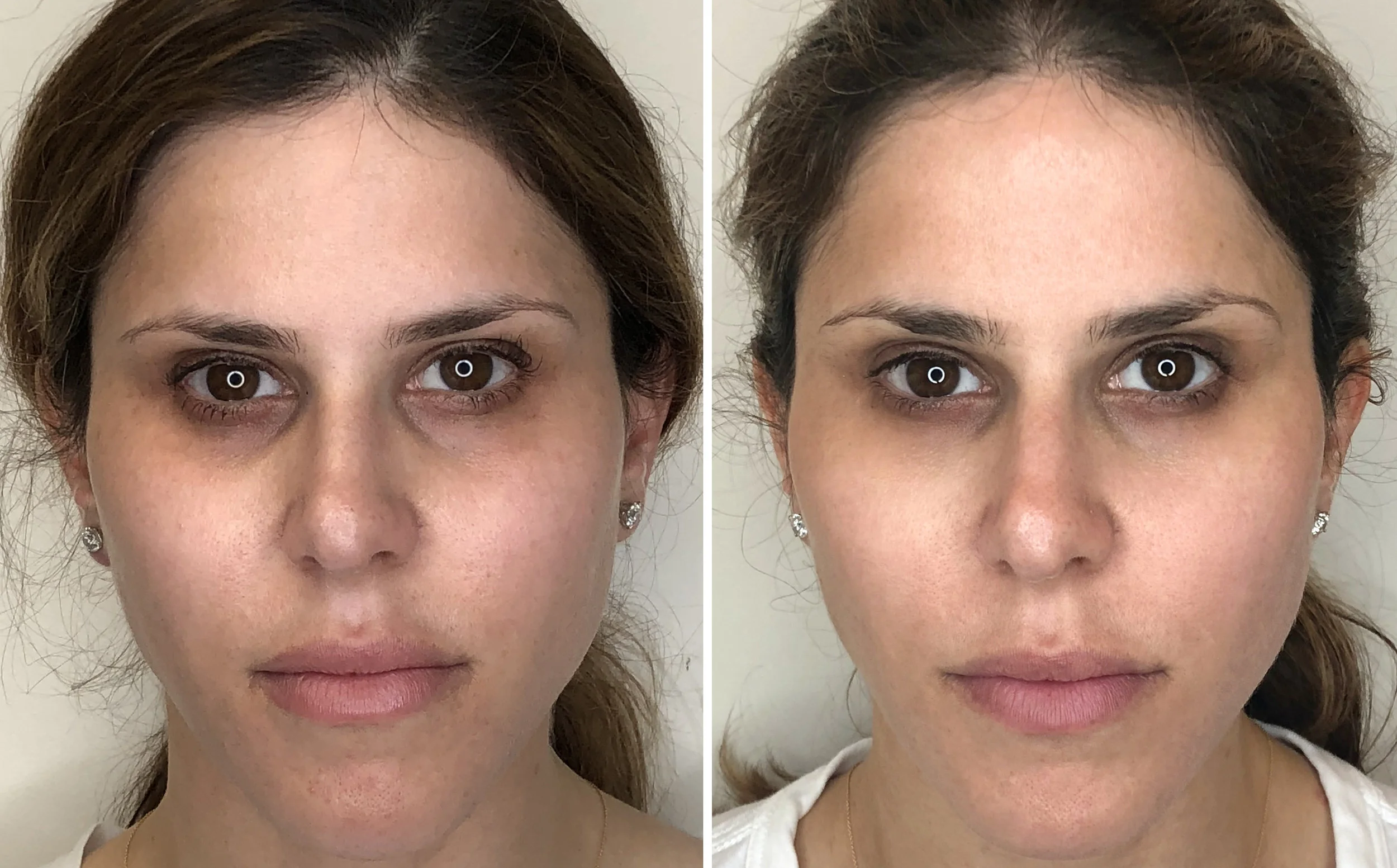 Before and After. I know it is hard to see because my skin started off pretty good, but overall the skin tone is more even, dark spots are lighter, and it looks more radiant overall.