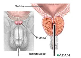 &nbsp; &nbsp; &nbsp;Transurethral access to the prostate.