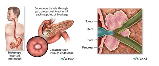 &nbsp; &nbsp; &nbsp; &nbsp; &nbsp; &nbsp; &nbsp; &nbsp; &nbsp; GI endoscopy and ERCP access to the pancreatic orifice