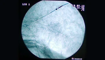 Animal trial: ArchMedical needle within pig's lung