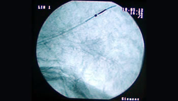 Animal trial: ArchMedical needle within pig's lung