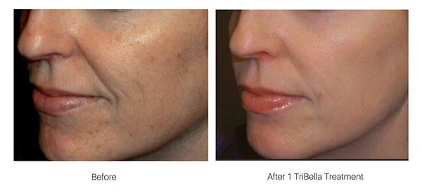 Before-&-After-TriBella.jpg