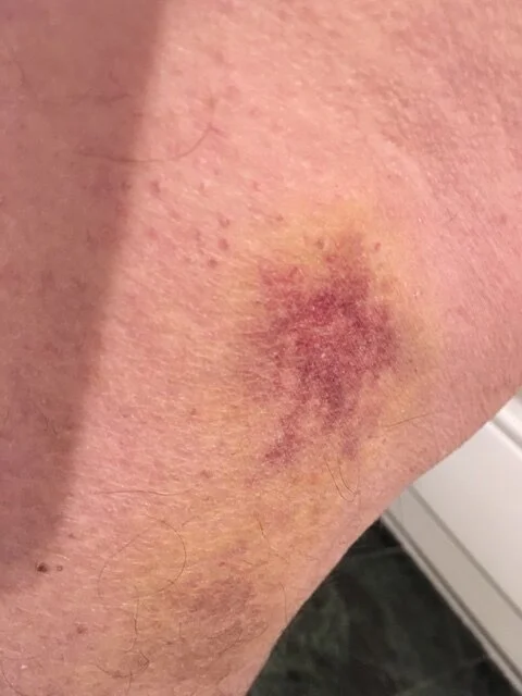 Ice Fall Bruise 1.JPG