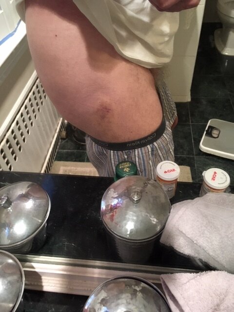 Bruise 1.JPG