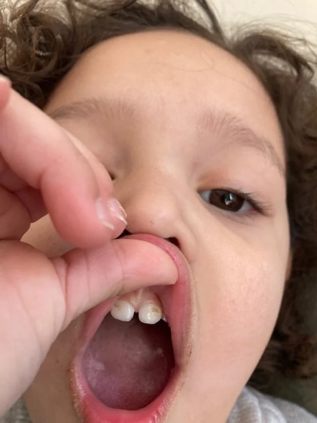 Cavities.jpg