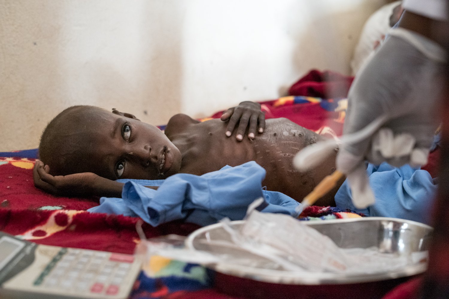  In einer Kinderklinik im Tschad gelingt es 2021, ein Kind vor dem Verhungern zu retten. Oft kommt die Hilfe zu spät. 
