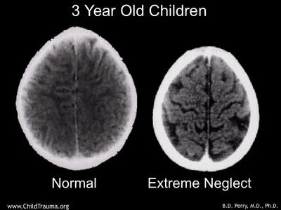 Brain scan in Bruce Perry’s research.