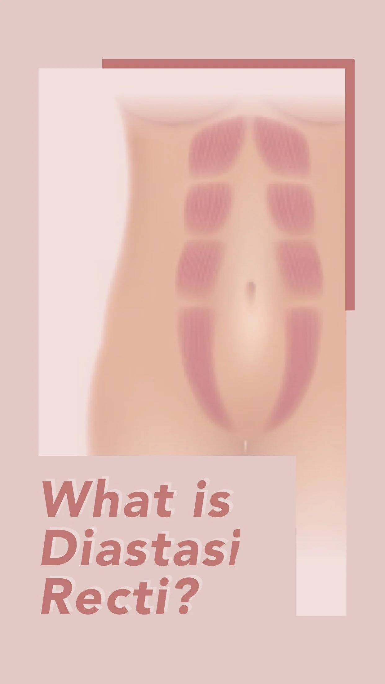 What is Diastasis Recti?