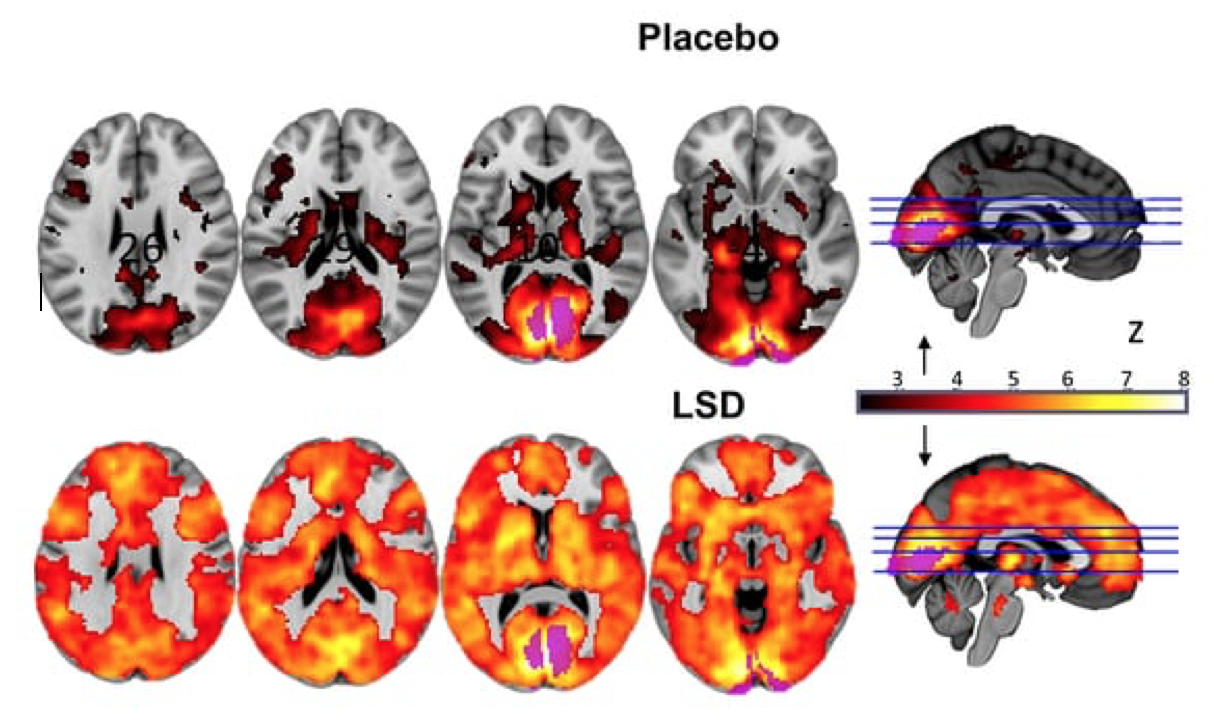 Figure 1: Differences in activation between participants on placebo and those on LSD. Image from Carhart-Harris and colleagues [8].