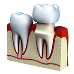 Crown Lengthening