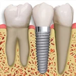 Dental Implants