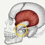 TMJ (Temporomandibular Joint Disorder)