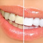 Teeth Whitening