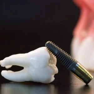 dental-implant-square-300x300.jpg