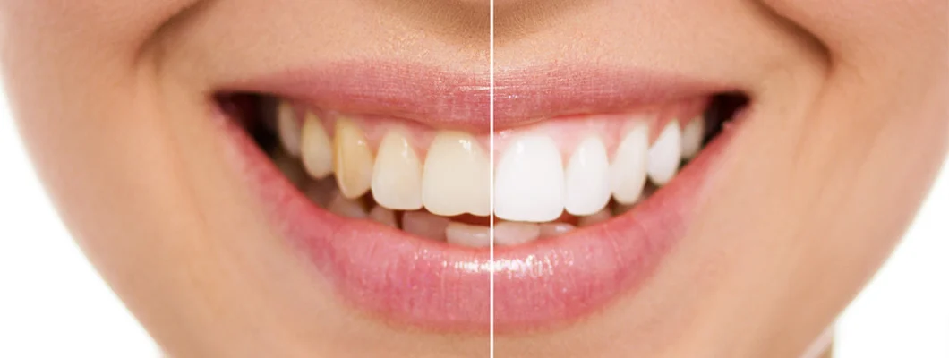 whitening_BLOG.jpg