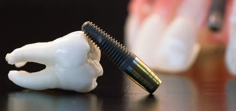 feature-image-implants.jpg