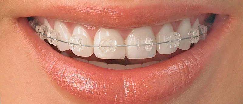 braces-web-size.jpg