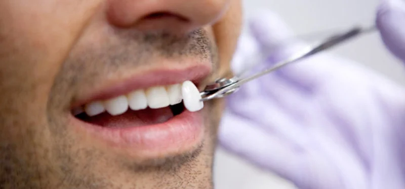 feature-image-veneers.jpg