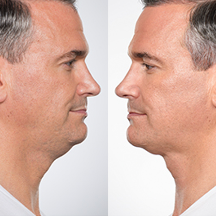 Kybella®
