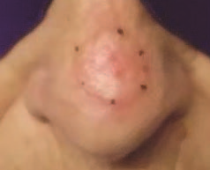 4th Treatment