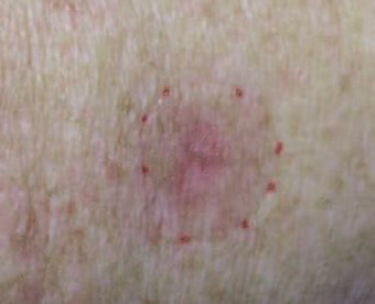 4th Treatment