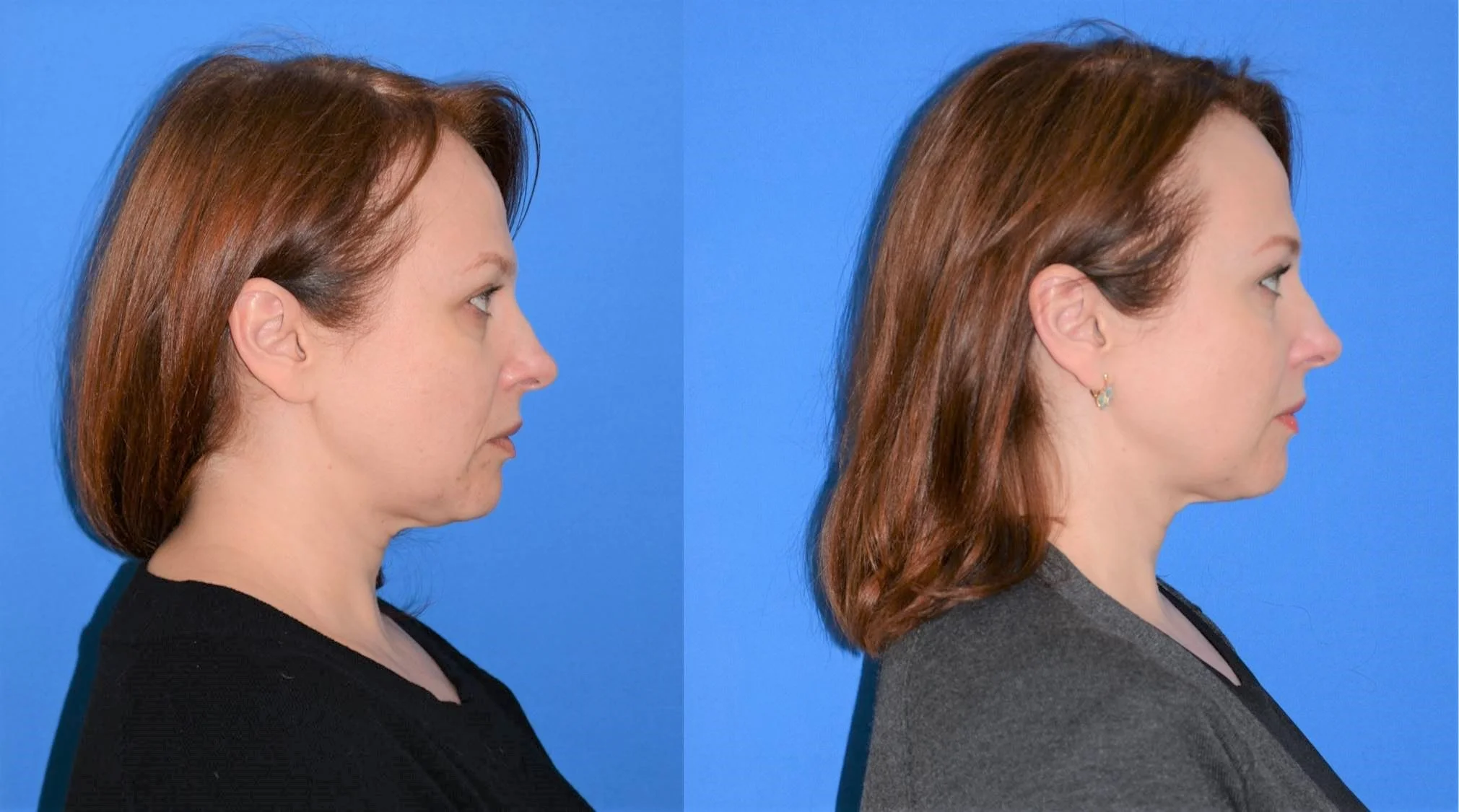 Our patient, 3 months post procedure. Total results are expected between 6 and 12 months post procedure. Notice the firmer, more defined profile and jawline.