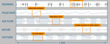 obstructive-sleep-apnea-diagnosis.jpg