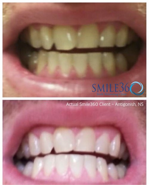 Actual before and after smile360 clients - husband and wife from antigonish nova scotia. Client Submitted photos.
