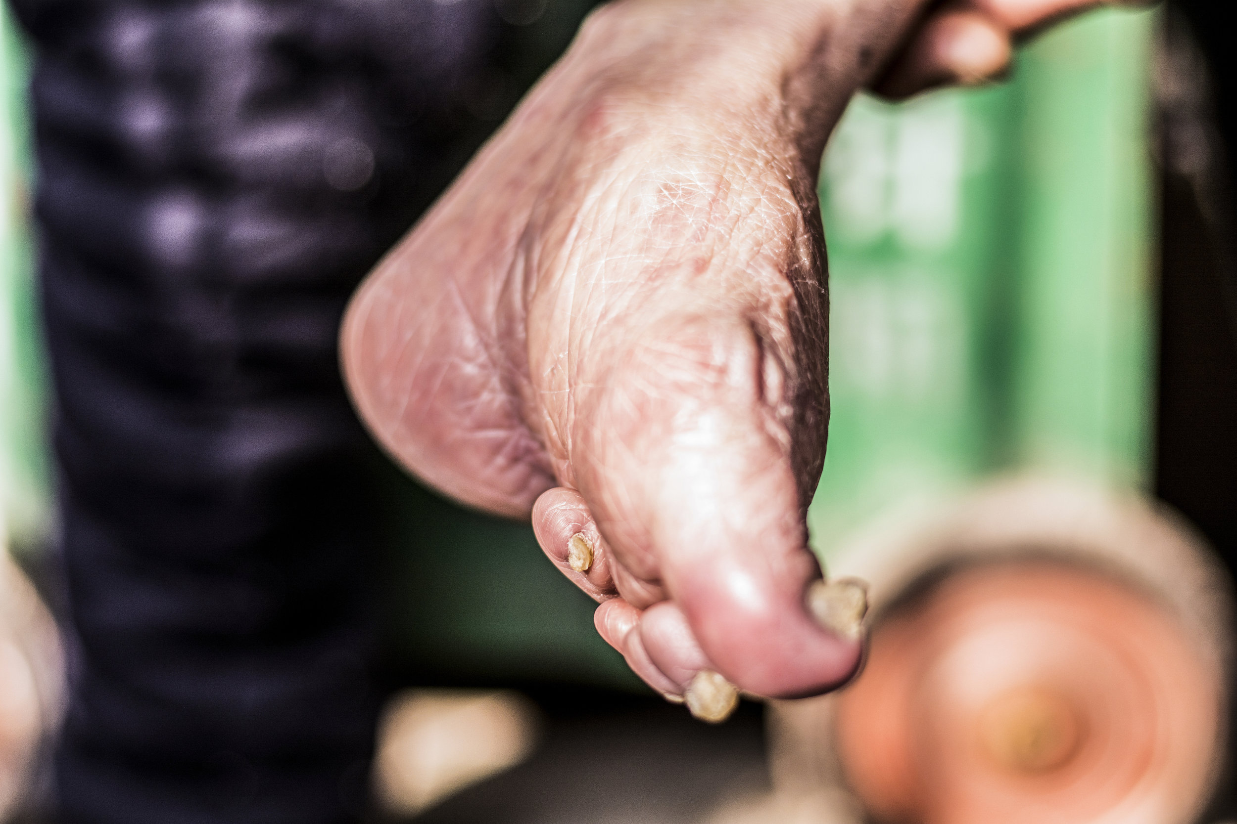 The foot-binding affected ability to walk. It is considered as a sign of the wealthy and high class. Girls from wealthiest part of society didn’t need walk or work in fields; they had servants to work for them.