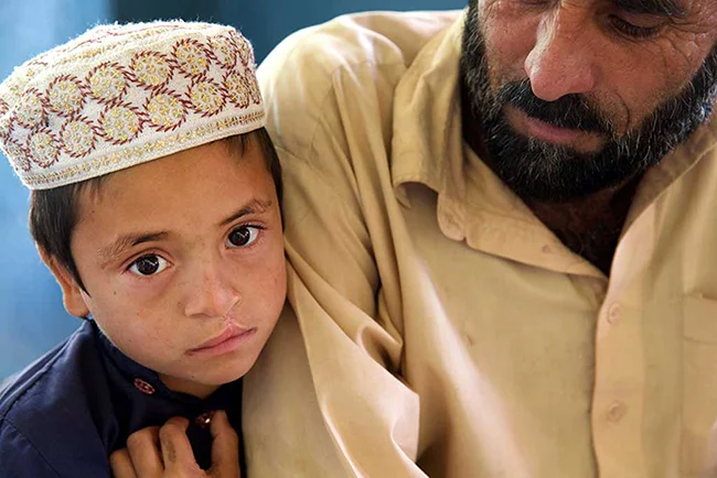 Child with a Cleft