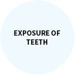 ExposureofTeeth.png