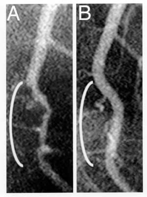 Figure 1 -- Coronary angiograms of the distal left anterior descending artery before (left) and after (right) 32 months of a plant-based diet without cholesterol-lowering medication, showing profound improvement.