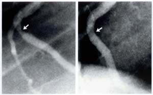 Figure 4--Coronary angiograms of right coronary artery before (left) and showing 30% improvement (right) following approximatemonths of a plant-based diet and cholesterol-lowering medication.