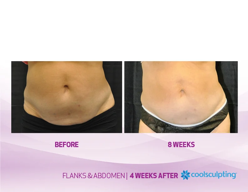 CoolsculptingBook_images9.jpg