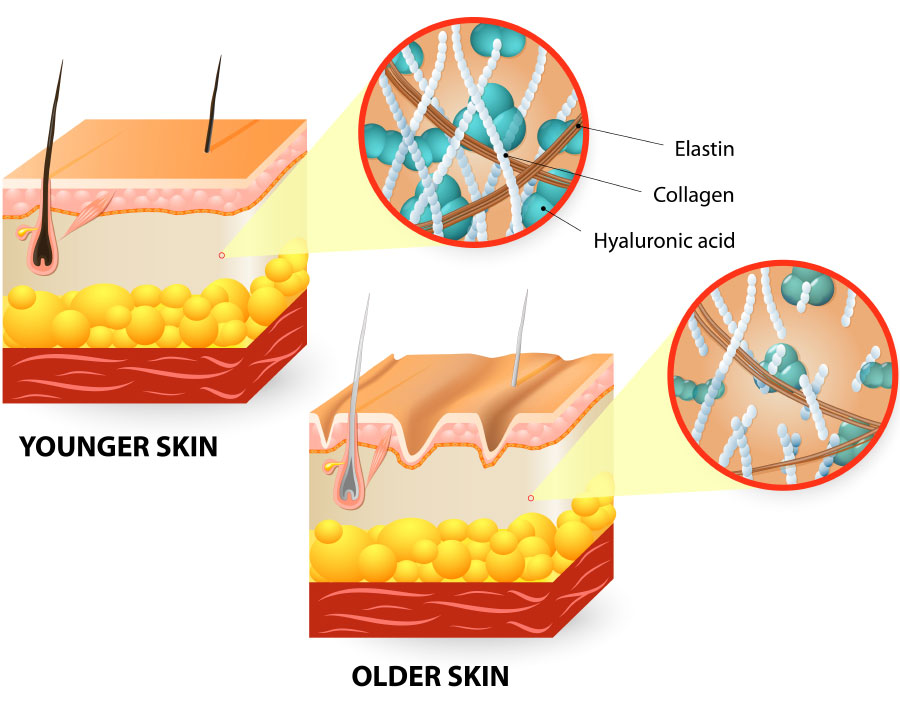 Notice the breakdown in collagen proteins in the older skin with apparent formation of wrinkles. 