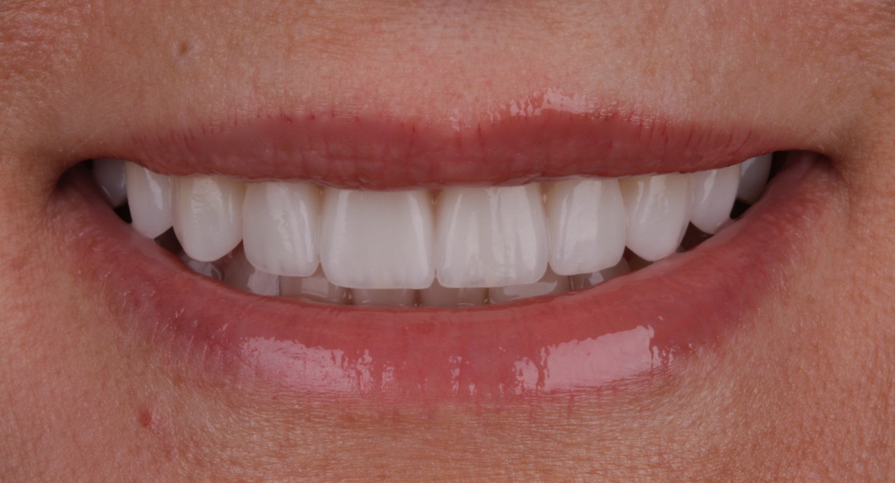 Dental Veneer Payment Plan Options in Houston, TX | Best Dental with Dr. Jasmine Naderi
