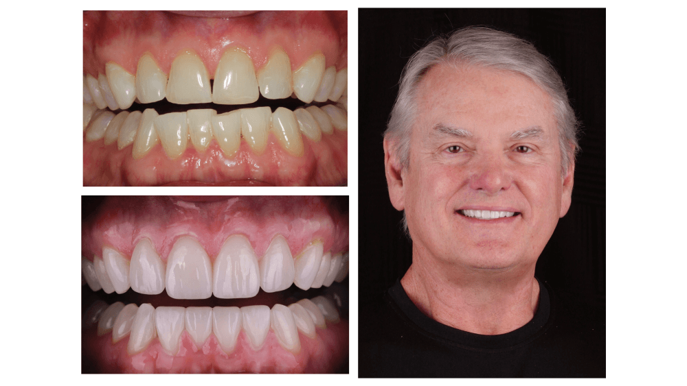 Cosmetic Dentistry Before After Photos, Porcelain Veneers Pictures