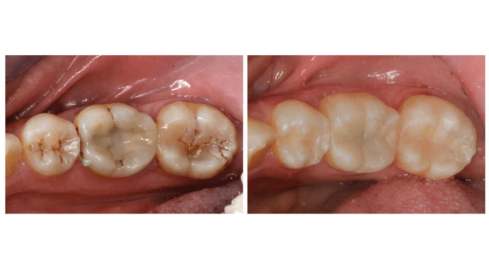 Palmetto Dental Associates — Tooth-colored Fillings