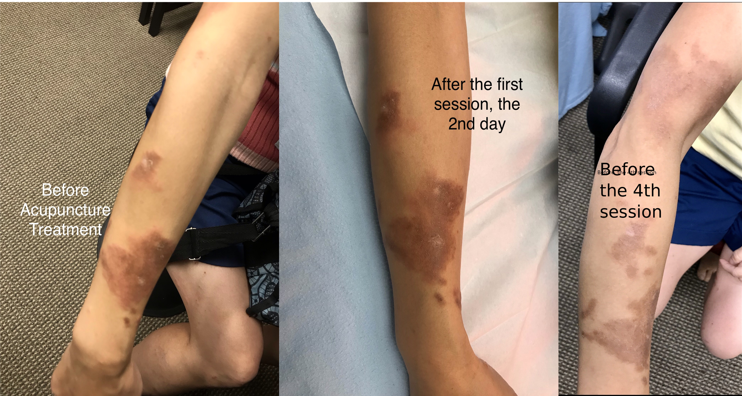 ReLife Acupuncture- Eczema-reddish and itchy