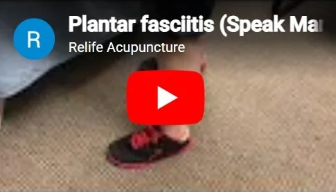 Acupuncture treatment for Plantar fasciitis.