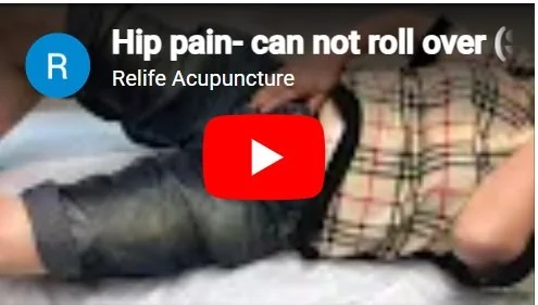 Acupuncture treatment for hip pain.