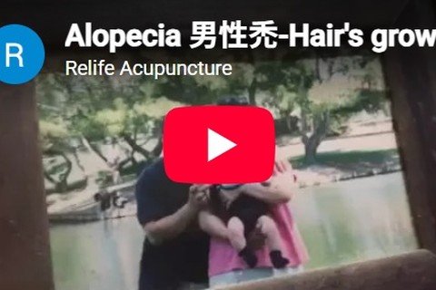 Re-Life Acupuncture treatment for alopecia.