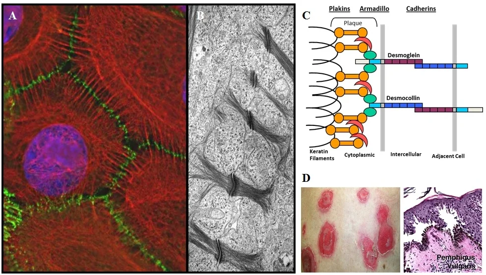 Figure 3: Desmosomes visualized by immunofluorescence (A) and electron microscopy (B). Organization of desmosomal components (C). Epidermal blistering in the human skin disease pemphigus (D).