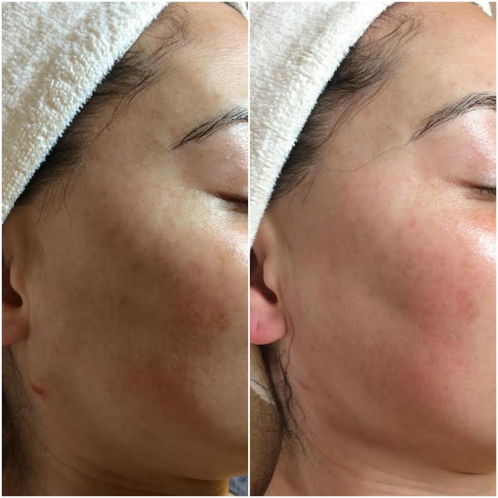  Tone/Texture evened out using Human Stemcell Microneedling 