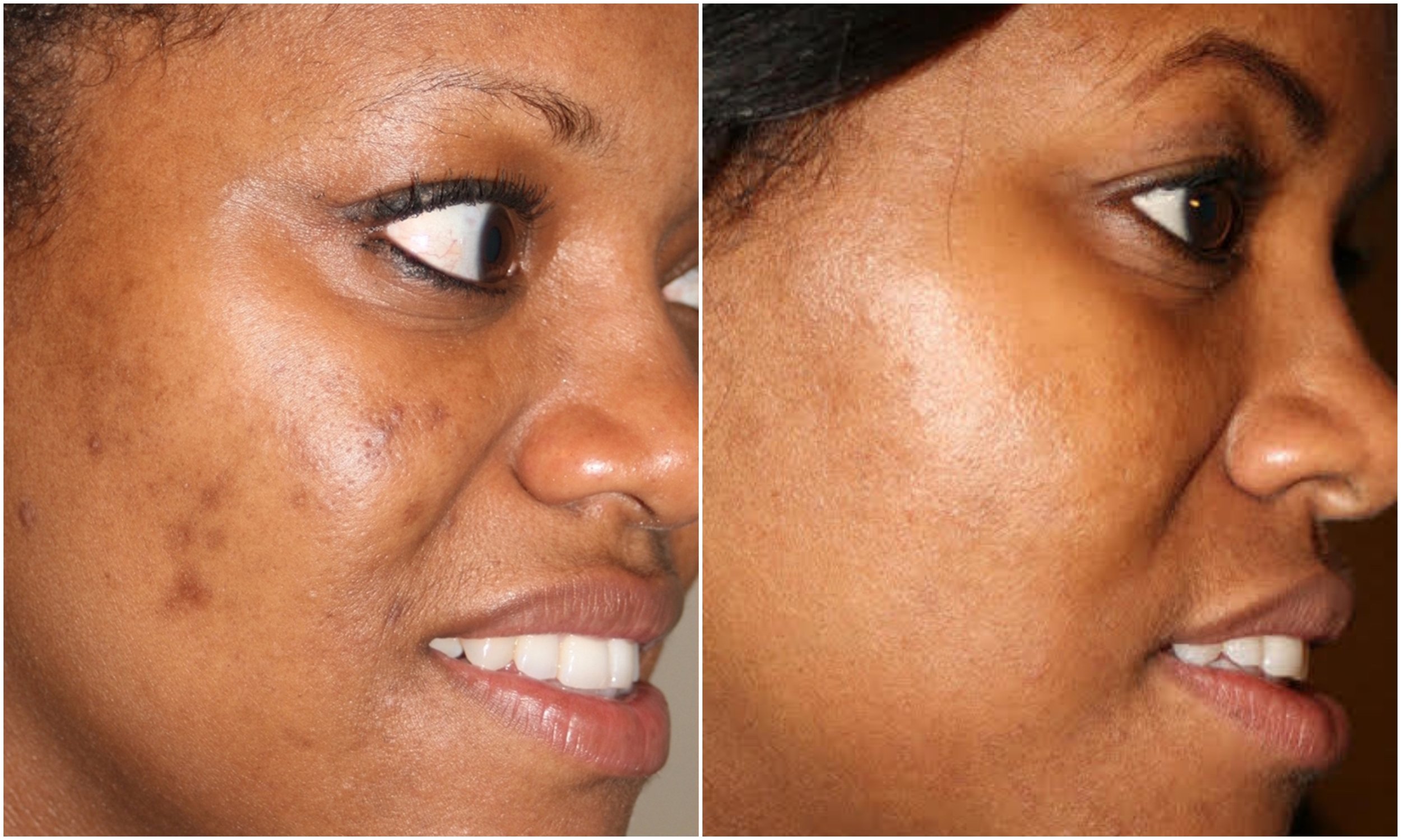   Blemishes cleared, tone/texture cleared using Perfect Derma Peel (Intense Peel)  