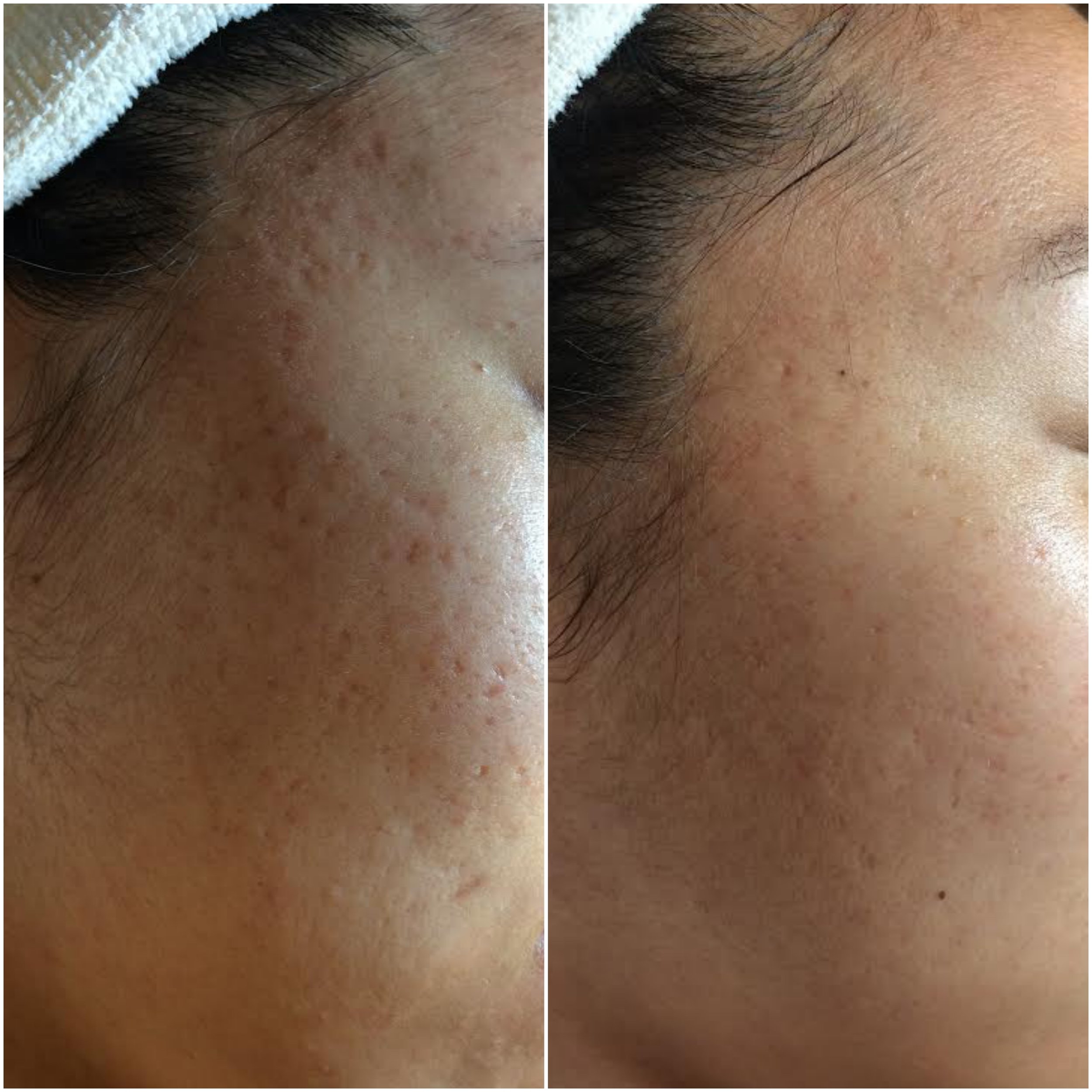  Acne pit scarring filled using human stem cell microneedling series 